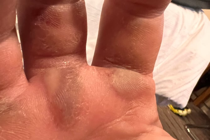 Blisters on Lee James' hands caused by rowing practice 